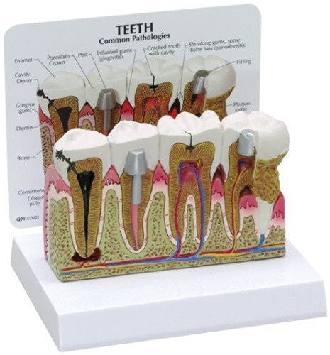 Buy Anatomical Chart Company Diseased Teeth and Gums Model  online at Mountainside Medical Equipment