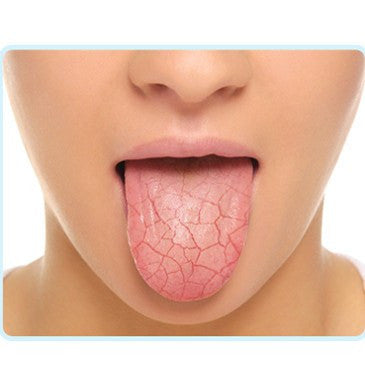 Dry mouth (also called xerostomia) is caused by an increase in saliva production within the glands in your mouth (salivary glands). 