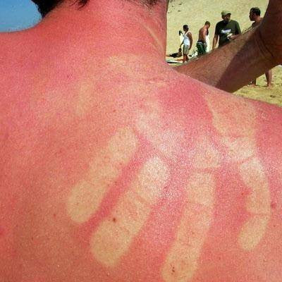 Sunburn Relief Products