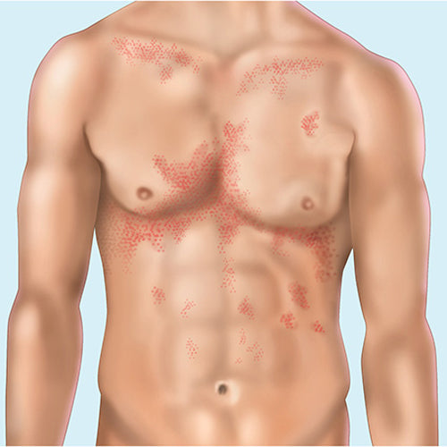 Syphilis Medications for effective STI treatment, essential in managing sexually transmitted infections and promoting sexual health.
