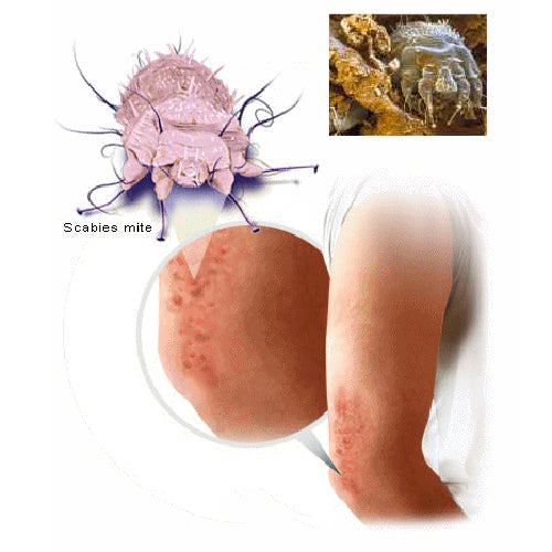 Treat Scabies