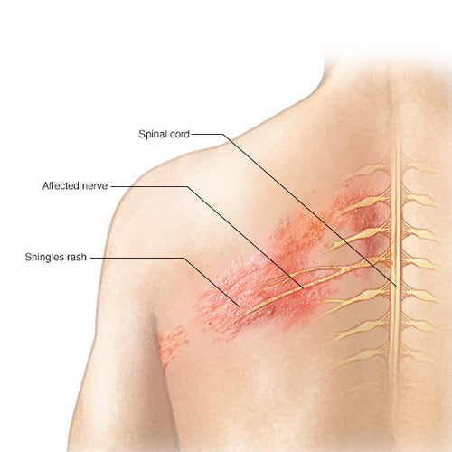Shingles Relief Medicines and Injections for pain relief and nerve health, promoting skin healing and reducing viral symptoms and discomfort.