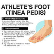 Athlete's Foot