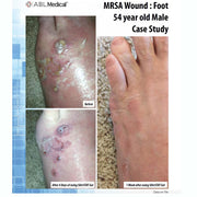 MRSA Wound Case Study for SilvrSTAT Silver Wound Gel