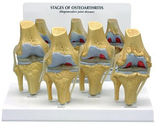 Buy n/a Four Stages of Osteoarthritis Model in The Knee Joint  online at Mountainside Medical Equipment
