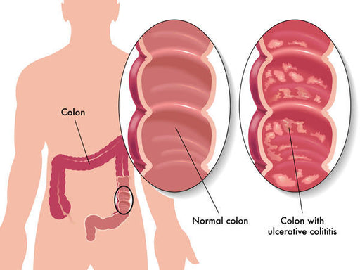 b12 injections ulcerative colitis Cost in Tyler, TX: Affordable Health Boost for Vitality Ulcerative Colitis Treatment Products -