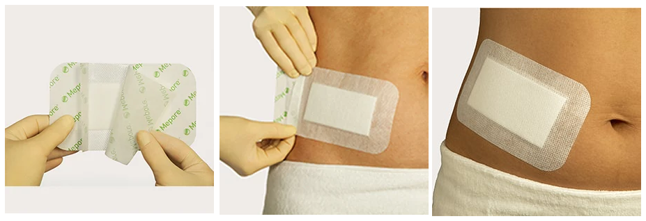 Mepore self adhesive deals dressing