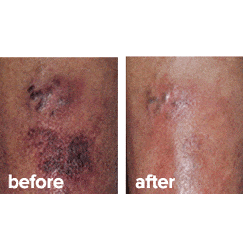 Dermend Moisturizing Bruise Formula Cream