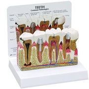 Buy Anatomical Chart Company Diseased Teeth and Gums Model  online at Mountainside Medical Equipment