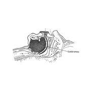 Buy ADC Berman Airways, Disposable (Each)  online at Mountainside Medical Equipment