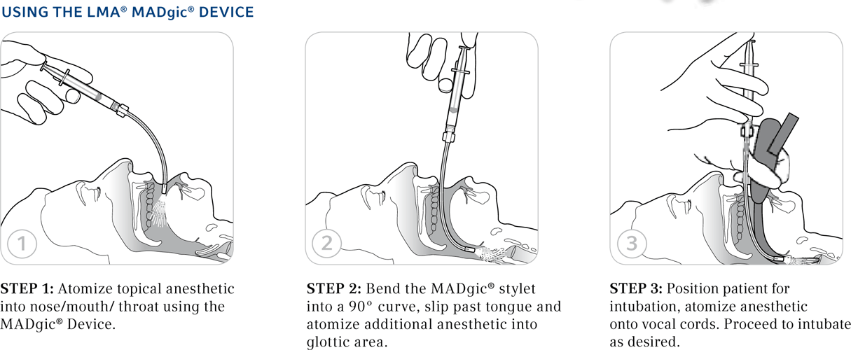 Atomization Device Laryngo-Tracheal Mucosal Atomization Device — Mountainside Medical