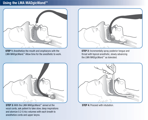Buy Teleflex LMA MADgicWand Mucosal Atomizer Device with 5 mL Syringe 20/Case  online at Mountainside Medical Equipment
