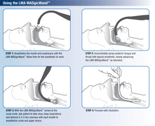 Buy Teleflex LMA MADgicWand Mucosal Atomizer Device with 5 mL Syringe 20/Case  online at Mountainside Medical Equipment