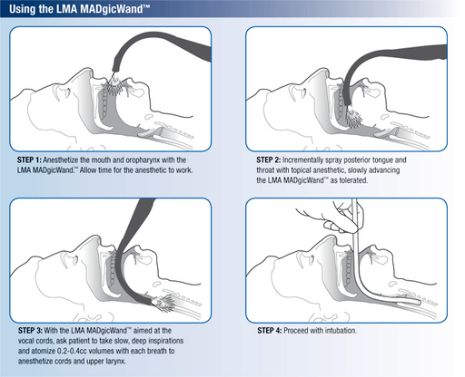 Buy Teleflex LMA MADgicWand Mucosal Atomizer Device with 5 mL Syringe 20/Case  online at Mountainside Medical Equipment