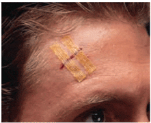 Buy 3M Healthcare Steri-Strips Antimicrobial Skin Closures ½” x 4”  online at Mountainside Medical Equipment