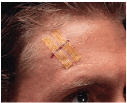 3M Healthcare Steri-Strips Antimicrobial Skin Closures ½” x 4” | Mountainside Medical Equipment 1-888-687-4334 to Buy