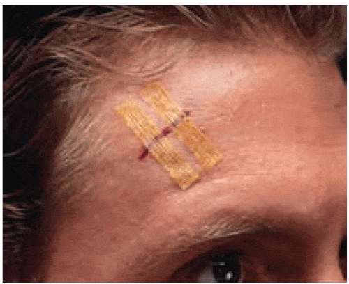 Buy 3M Healthcare Steri-Strip Antimicrobial Skin Closures 1/8” x 3”  online at Mountainside Medical Equipment