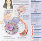 Understanding Type 1 Diabetes Poster 20 x 26