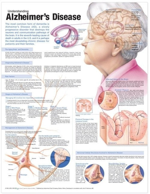 Alzheimer's | Understanding Alzheimer's Disease Informational Poster